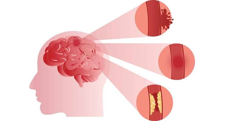 Best Stroke Treatment Doctors in Bhubaneswar