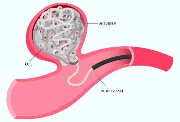 Brain Aneurysm Treatment Doctors In Bhubaneswar