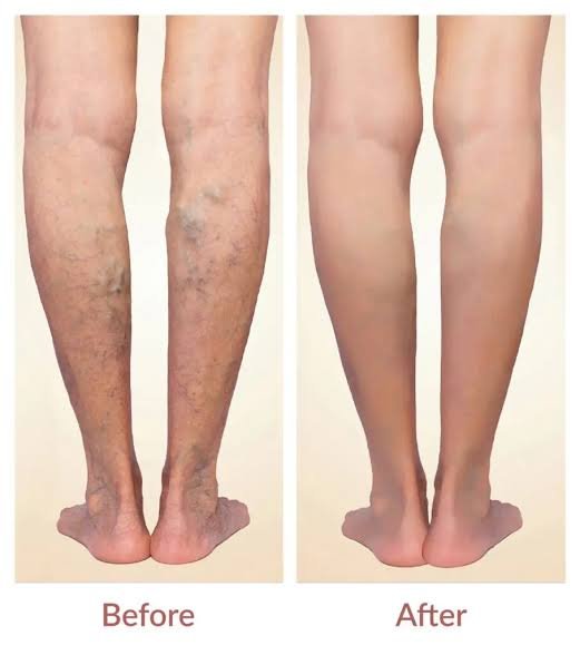 Varicose Veins Treatment in Bhubaneswar