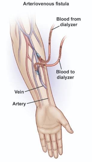 Deep Vein Thrombosis Surgery in Bhubaneswar