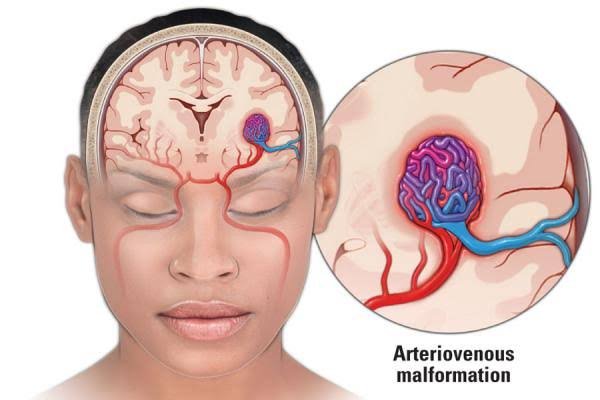 Best Embolism Treatment in Bhubaneswar