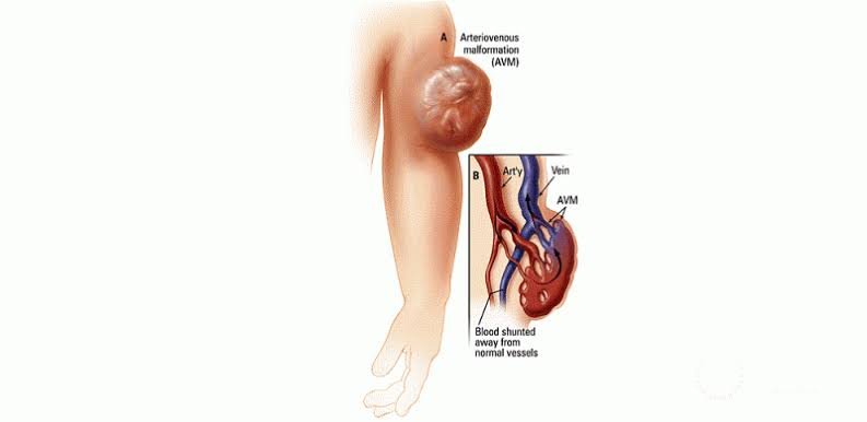 Best Arteriovenous Malformation Doctors in Bhubaneswa